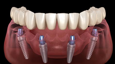 Fixed Dentures All You Need To Know