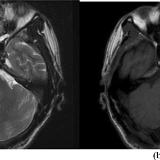 Axial T A And T Weighted B Sections Of Mri Brain Show Decreased