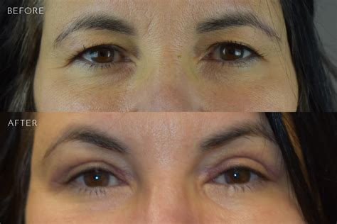 Eyelid Lift Before And After Photos Kirkland Bellevue Marina Park