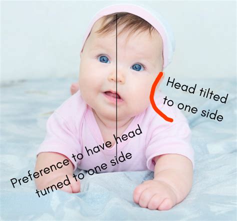 Torticollis Baby Exercises - Learn Exercises For Your Baby With ...