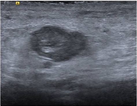 Groin Lymph Nodes Ultrasound