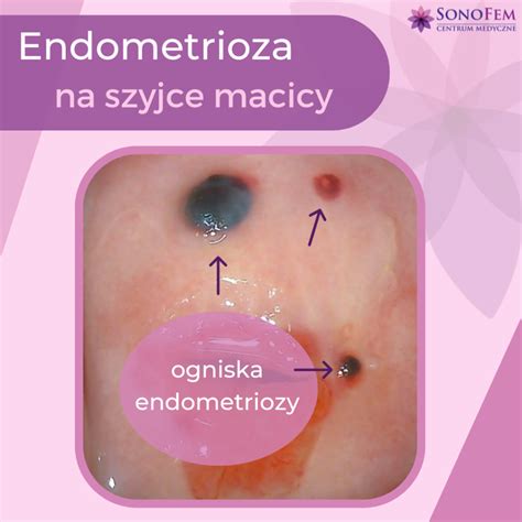 Laserowe Usuwanie Endometriozy Z Szyjki Macicy Sonofem Centrum