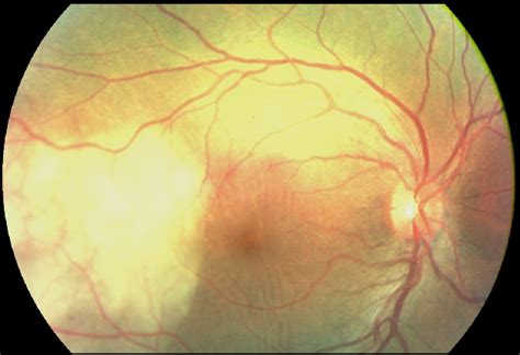 Figure 1 From Nodular Posterior Scleritis Mimicking Choroidal