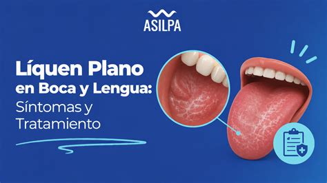 Liquen Plano Na Lingua - Líquen Plano en Boca y Lengua: Síntomas y Tratamiento | Clínca Dental ...