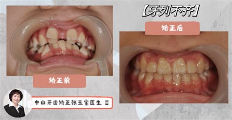 儿童门牙重叠长两颗儿童牙齿错位图片叠牙是什么引起的大山谷图库