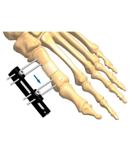 Foot Lengthening Treatment Orthofix ABS