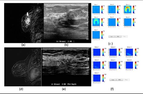 Figure 4 From Ultrasound Guided Diffuse Optical Tomography For