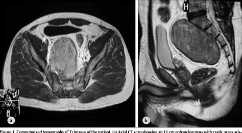 Figure From Surgical Resection Combined With Preoperative