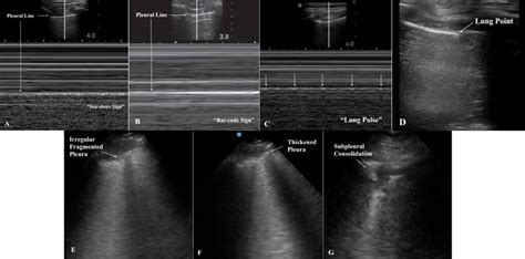 M Mode For Diagnosis Of Pneumothorax And Pleuroparenchymal