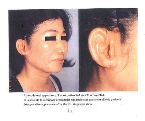 Secondary Auricular Reconstruction 5Nagata Microtia And