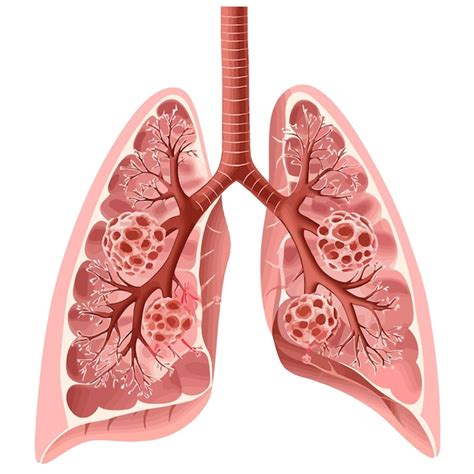 Lung Cancer Diagram In Details Vector Vetor Premium