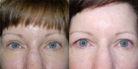 Before/after melanin therapy facial image samples [23] | Download ...