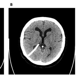 Investigations supporting hydrocephalus and shunt dysfunction: (A) CT... | Download Scientific ...