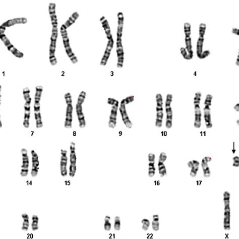 PDF Prenatal Diagnosis Of Mosaic Tetrasomy 18p