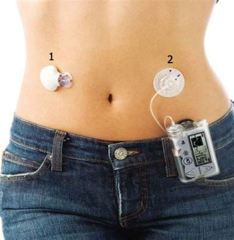 Інсулінова помпа для постачання інсуліну 24/7 | БФ Допомоги та ...