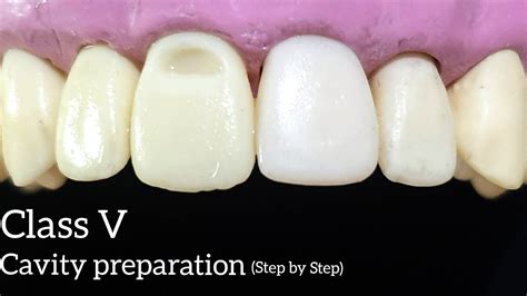 Class V Cavity Preparation Step By Step With Explanation Upper Incisor