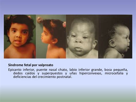 Síndrome Fetal Del Valproato Ecured