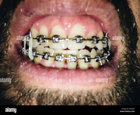 Man Braces Close Up Hi Res Stock Photography And Images Alamy