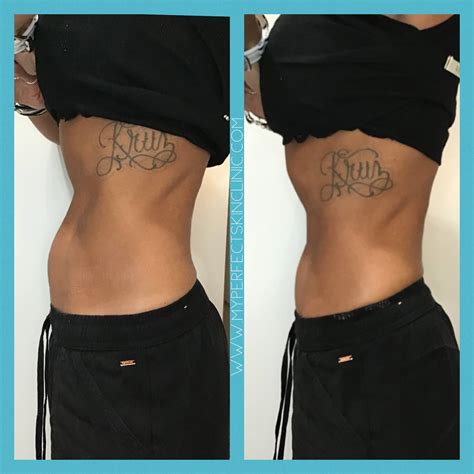 Body Contouring Treatment Body Sculpting Coolsculpt Gilbert Az