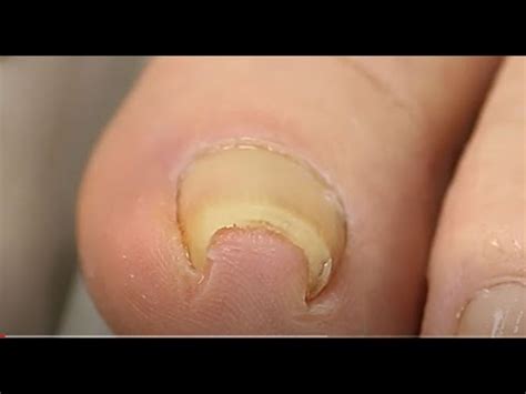 How To Cut Curved And Deep Ingrown Toenail Removal Curved Nail