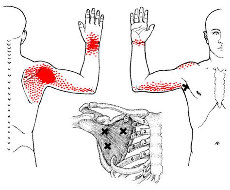 Referred Pain Pattern From Subscapularis Muscle Mtrp The Referred Pain