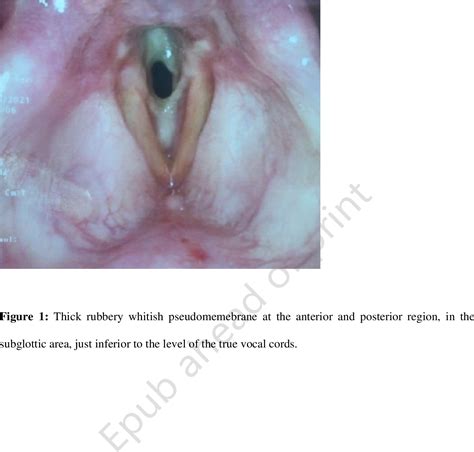 Figure 1 From Obstructive Fibrinous Pseudomembrane Tracheitis After Double Lumen Tube Intubation