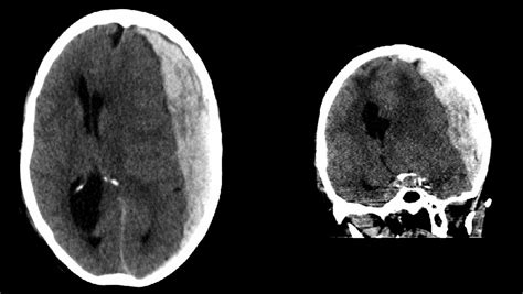 acute subdural haematoma radiology  st vincents university hospital