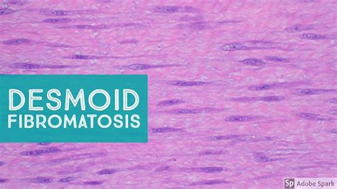 Desmoid Fibromatosis (Desmoid Tumor) - Explained by a Soft Tissue ...