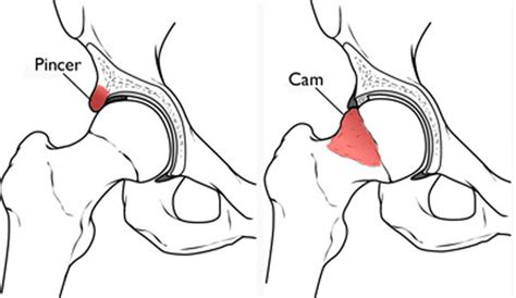 Fai Faq S Dr Rice Cam Impingement And Pincer Impingement Cincinnati