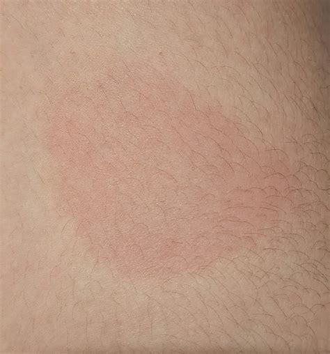 Rash On Thigh For A Few Months Now Anyone Know What It May Be R Dermatologyquestions