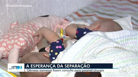 Mãe Traz Gêmeas Siamesas De São Paulo A Goiás Para Consulta Sobre Cirurgia De Separação Vamos