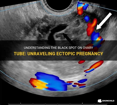 Understanding The Black Spot On Ovary Tube Unraveling Ectopic