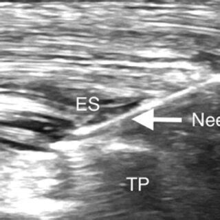 Ultrasound-guided erector spinae plane block. The needle is inserted ...