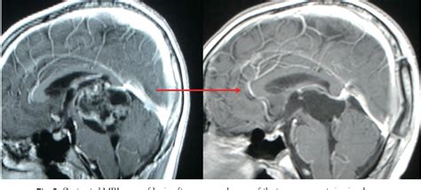 Figure 1 From A Case Report Of Growing Teratoma Syndrome In A Patient