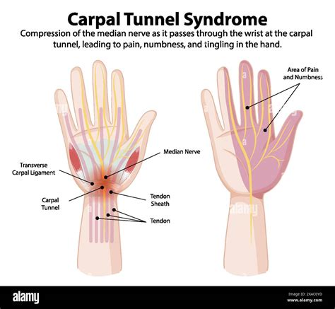 Diagram showing carpal tunnel syndrome symptoms Stock Vector Image ...