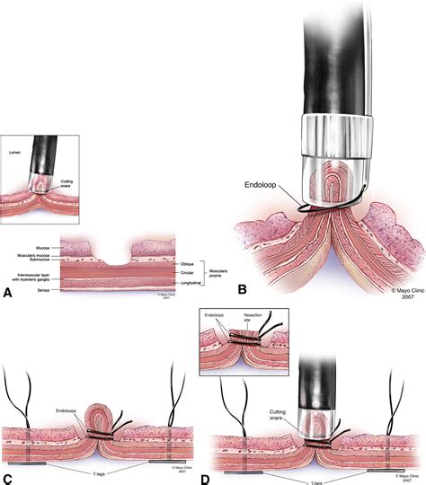 Figure 1 From Endoscopic No Hole Full Thickness Biopsy Of The Stomach To Detect Myenteric