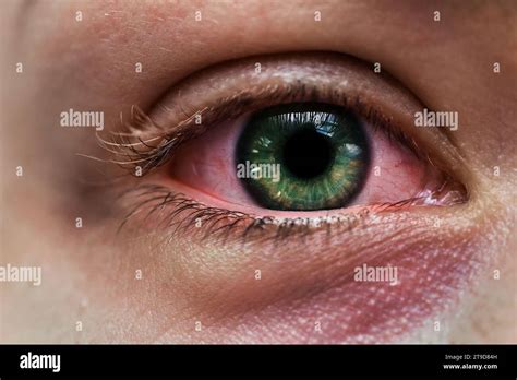 Closeup Of Infected Female Eye With A Green Iris And Subconjunctival