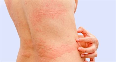 Urticaria En La Piel Qué Es Síntomas Y Tratamiento