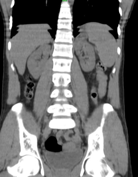 Ct Abdomen Contrast And Urogram Teleradwin