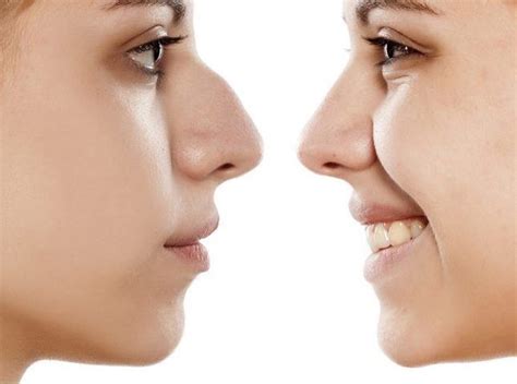 Nose Job Surgery (Rhinoplasty) | Cape Town