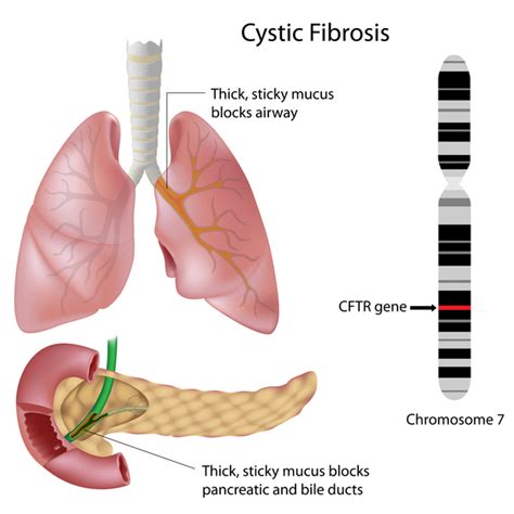 Cystic Fibrosis Genetics Home Reference Nih