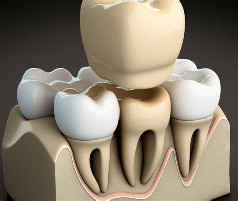 Types Of Crowns – Everything You Should Know - SmileWide Dental Clinic