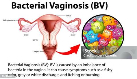 Infografis Bacterial Vaginosis Dengan Penjelasan Ilustrasi Stok Unduh Gambar Sekarang Istock