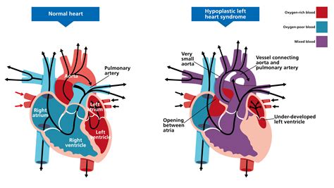 Hypoplastic left heart syndrome — Knowledge Hub