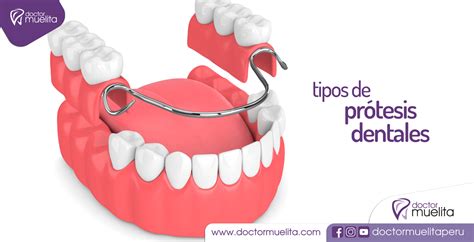 Los Tipos De Protesis Dentales Images