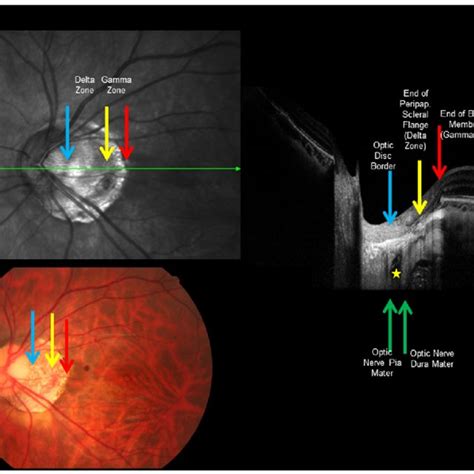 Fundus photograph of a highly myopic eye with myopic maculopathy ...