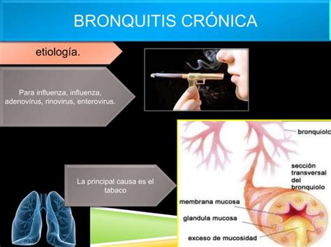 Epoc Enfisema Bronquitis Crónicabronquiectasia Y Asma