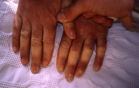 Nail Diseases Lichen Planus Of The Nails Picture Hellenic