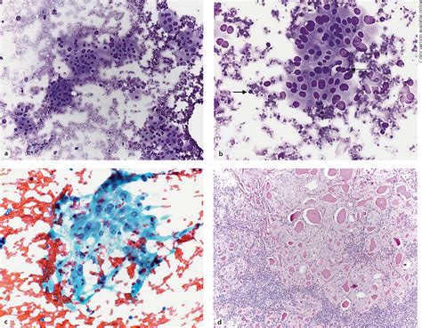 Figure 1 From Fine Needle Aspiration Cytology Of Thyroid Nodules With Hürthle Cells