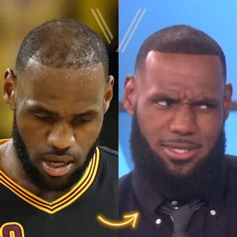 Lebron James Hair Transplant Before And After Transformation